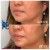 Lower Face Filler treatment 10 thumbnail
