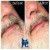 Lower Face Filler treatment 11 thumbnail