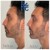 Lower Face Filler treatment 12 thumbnail