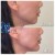 Lower Face Filler treatment 14 thumbnail