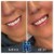 Lower Face Filler treatment 15 thumbnail