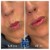 Lower Face Filler treatment 16 thumbnail