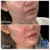 Lower Face Filler treatment 17 thumbnail