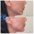 Lower Face Filler treatment 2 thumbnail