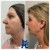 Lower Face Filler treatment 20 thumbnail