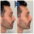 Lower Face Filler treatment 21 thumbnail
