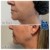 Lower Face Filler treatment 22 thumbnail