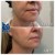 Lower Face Filler treatment 23 thumbnail