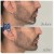 Lower Face Filler treatment 24 thumbnail