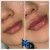 Lower Face Filler treatment 25 thumbnail