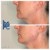Lower Face Filler treatment 26 thumbnail