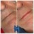 Lower Face Filler treatment 28 thumbnail