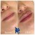Lower Face Filler treatment 3 thumbnail
