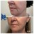 Lower Face Filler treatment 30 thumbnail
