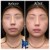 Lower Face Filler treatment 31 thumbnail