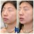 Lower Face Filler treatment 32 thumbnail