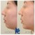 Lower Face Filler treatment 33 thumbnail