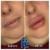 Lower Face Filler treatment 34 thumbnail