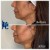 Lower Face Filler treatment 36 thumbnail