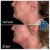 Lower Face Filler treatment 37 thumbnail