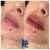 Lower Face Filler treatment 38 thumbnail