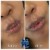 Lower Face Filler treatment 39 thumbnail