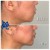 Lower Face Filler treatment 4 thumbnail