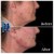 Lower Face Filler treatment 40 thumbnail
