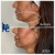 Lower Face Filler treatment 41 thumbnail