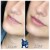 Lower Face Filler treatment 42 thumbnail
