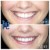Lower Face Filler treatment 43 thumbnail
