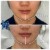 Lower Face Filler treatment 44 thumbnail