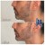 Lower Face Filler treatment 47 thumbnail