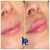 Lower Face Filler treatment 48 thumbnail