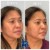 Lower Face Filler treatment 49 thumbnail
