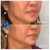 Lower Face Filler treatment 50 thumbnail