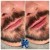 Lower Face Filler treatment 51 thumbnail