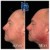 Lower Face Filler treatment 7 thumbnail