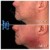 Lower Face Filler treatment 8 thumbnail