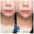 Lower Face Filler treatment 9 thumbnail