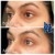 Middle Face Filler treatment 11 thumbnail