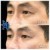 Middle Face Filler treatment 12 thumbnail