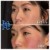 Middle Face Filler treatment 13 thumbnail