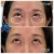 Middle Face Filler treatment 15 thumbnail