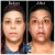 Middle Face Filler treatment 16 thumbnail
