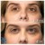 Middle Face Filler treatment 17 thumbnail