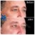 Middle Face Filler treatment 18 thumbnail