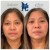 Middle Face Filler treatment 19 thumbnail