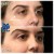 Middle Face Filler treatment 2 thumbnail