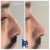 Middle Face Filler treatment 21 thumbnail
